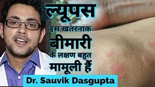 Lupus disease  ल्यूपस बीमारी का Symptom और treatment क्या है। sle disease in hindi [upl. by Nalyak223]