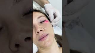 Lift and tighten your undereye skin without surgery using Endolaser undereyewrinkles short [upl. by Zola]