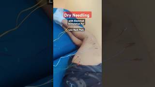 Dry Needling with Electrical Stimulation for Low Back Pain needling dryneedling physio LBP [upl. by Vasos412]