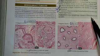 Fibroadenoma fully Explained Pathology ⚕️ [upl. by Notned53]