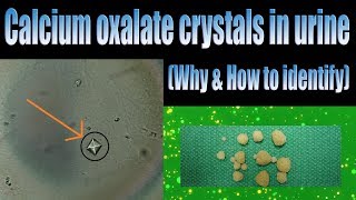 Calcium oxalate crystals in urine Why amp How to identify [upl. by Airamahs]