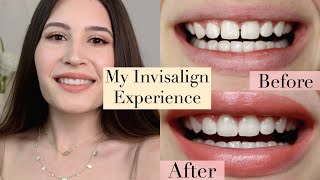 My Experience with Invisalign [upl. by Ylatan]