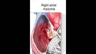 Atrial MyxomaTumor Plop soundIschemiaDr Zeshan Shigri [upl. by Cherlyn]