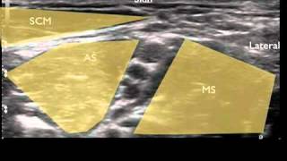 Ultrasound Guided Interscalene Nerve Block [upl. by Dihsar]