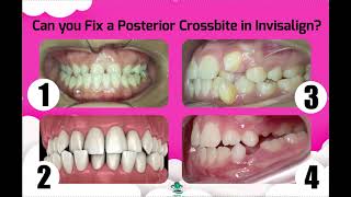 Adults Should you Attempt to Fix a Posterior Crossbite Invisalign amp ClearCorrect [upl. by Eidas645]