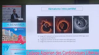 Infarctus du myocarde chez les femmes [upl. by Melanie]