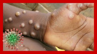 Monkeypox Overview and Symptoms MONKEYPOX CASES DETECTED IN US [upl. by Enylecoj]