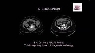 Intussusception [upl. by Cavanagh]