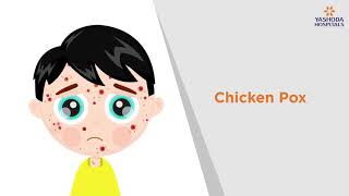 Chicken Pox Symptoms Causes Prevention and Treatment  Yashoda Hospitals [upl. by Htir]