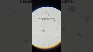 Calcium Oxalate Monohydrate Crystals in Urine Microscopicpathology [upl. by Ettegroeg]