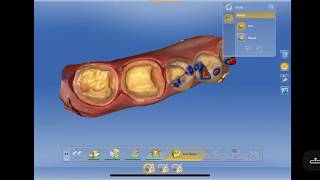 CEREC Crowns 3031 Inlay 29 [upl. by Yelkreb]