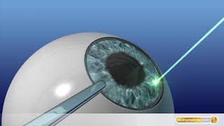 AugenOP mit Laser So funktioniert LASIK [upl. by Ragde913]