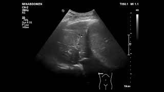 huge lung cancernecrotizing pneumonia [upl. by Zaccaria]