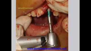 Immediate Implant placement fractured central incisor [upl. by Omland775]