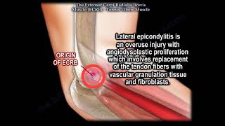 Tennis Elbow Muscle Extensor Carpi Radialis Brevis Everything You Need To Know Dr Nabil Ebraheim [upl. by Brittain]