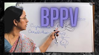 026 Benign Paroxysmal Positional Vertigo BPPV [upl. by Notsrik317]