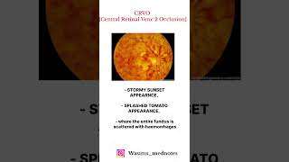 High Yield topic 💯💯🔥🔥CRVO Central Retinal Venc 2 Occlusion crvo opthalmology eye [upl. by Gal]