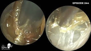 244  Why is this Eardrum Pulsating after Ear Wax Removal using the WAXscope®️ [upl. by Eseila]