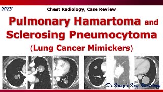 Pulmonary hamartoma amp Sclerosing pneumocytoma [upl. by Nryhtak]