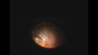 Vitrectomy and Perfluoron for Retinal Detachment with Giant Retinal Tear [upl. by Airemahs]