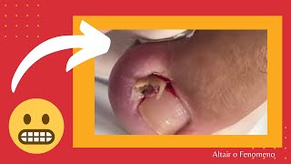 UNHAS ENCRAVADAS 2020 ALIVIO VIDEOS INCRIVEIS NAILED NAILS [upl. by Caylor]