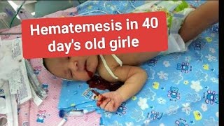 Hematemesis in 40 days age [upl. by Akers]