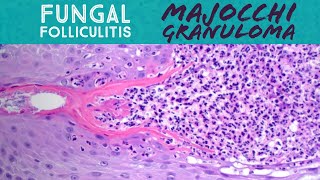 Majocchi granuloma fungal folliculitis by dermatophyte tinea “ringworm” fungus dermatology [upl. by Waddell]