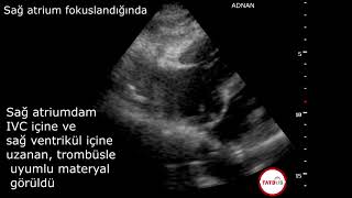 Aritmi Yönetiminde Kardiyak ultrason Vaka Sunumu [upl. by Oremodlab]