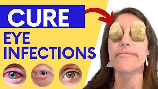 How to Treat Eye Infections Eye Allergies and Pink Eye Naturally at Home [upl. by Aimik]