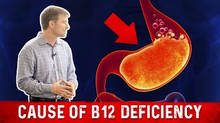 Vitamin B12 Deficiency The most common Cause – Dr Berg [upl. by Dnomaid]