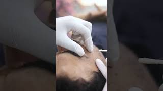 Skinaa Clinic Xanthelasma Treatment Video viral shorts skinaaclinic [upl. by Nalek]