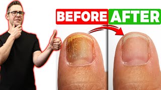 BEST Toenail Fungus Treatment 2024 4 BIG SECRETS [upl. by Obeng365]