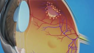 Prophylactic Laser Photocoagulation Laserpexy for Retinal Tear [upl. by Aennaej]