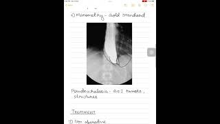 Achalasia cardia surgeryneetpg [upl. by Kylen33]