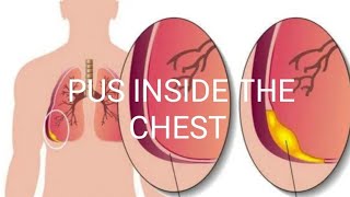 PUS INSIDE THE CHESTEMPYEMA [upl. by Liebermann]