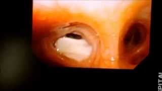 hydatid cyst lung Bronchoscopic view [upl. by Theis]