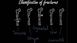 Classifying and presenting Fractures  Orthopaedics for Medical Students  Finals [upl. by Middleton]