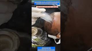 hair transplantation first hair wash in shubiksha hair and skin care clinic Trichy 19 [upl. by Kamal]