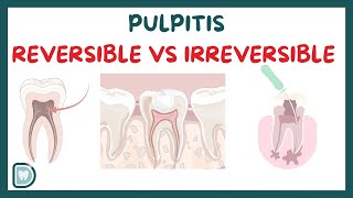 Reversible Pulpitis Vs Irreversible Pulpitis Symptoms Diagnosis Testing and Management [upl. by Hafinah146]