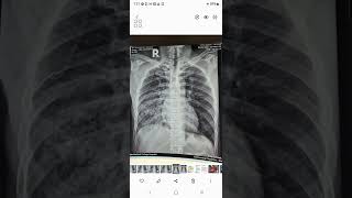 Pneumomediastinum CXR [upl. by Namas722]