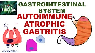 AUTOIMMUNE ATROPHIC GASTRITIS Pathogenesis clinical features morphology amp prognosis [upl. by Libove]