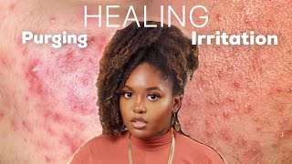 PURGING OR IRRITATION  Esthetician Explains How to Identify and Treat Both Conditions [upl. by Gilliette]