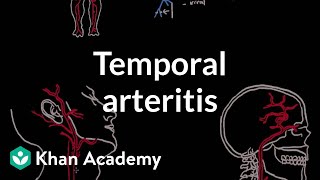 Temporal arteritis  Circulatory System and Disease  NCLEXRN  Khan Academy [upl. by Rebmac]