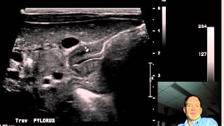 Pyloric Stenosis ULTRASOUND DISCUSSION 2 [upl. by Peppard961]