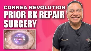 Corneal RK Radial Keratotomy Repair with Topographic Guided Ablation [upl. by Fulvia]