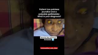 Patient has painless jaundice and apalpable gallbladderWhat is your diagnosis [upl. by Enitsuga]