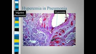 Pathology of congestion Vs Hyperemia [upl. by Kayle]