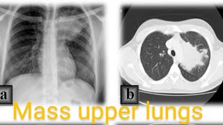 ct scan chest plain  soft tissue mass left lung upper and lover lobs  DD pleural based mass lesion [upl. by Edya]