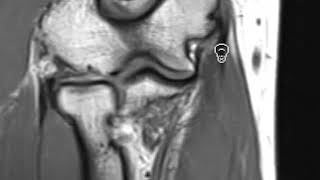 Biceps Tendinopathy and Medial Epicondylitis [upl. by Esahc991]