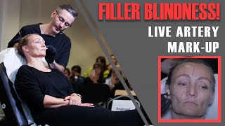 Filler Blindness Dr Tim marks up his patients dangerous arteries LIVE Aesthetics Mastery Show [upl. by Malonis]